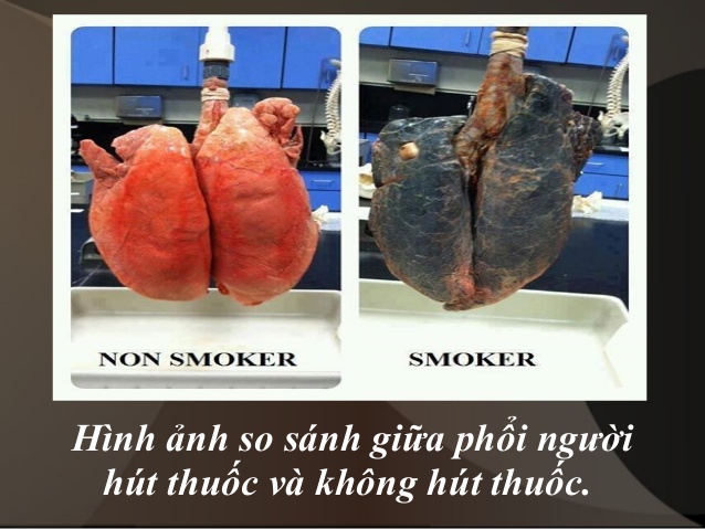 Hình ảnh so sánh giữa phổi người không hút thuốc và người hút thuốc